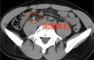 一汽总医院完成省内首例日间手术模式下电子胆道镜联合肠镜阑尾炎取石术